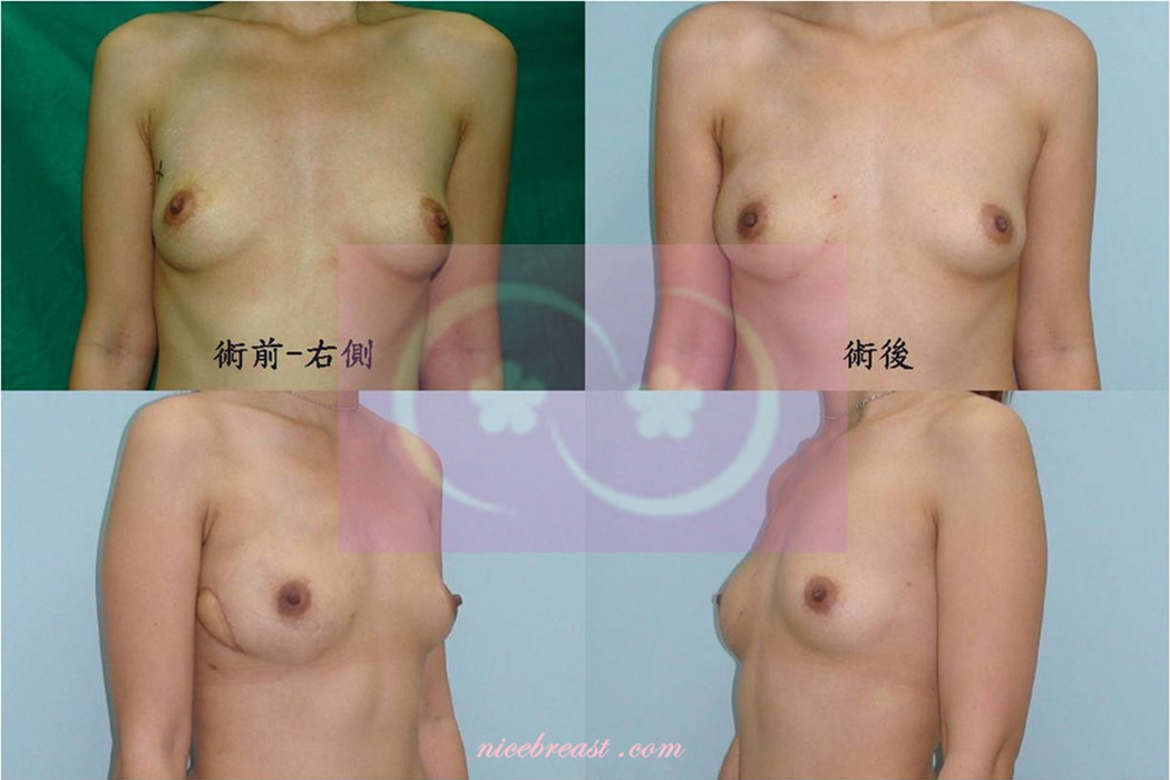 立即性乳房重建-右乳乳頭保留