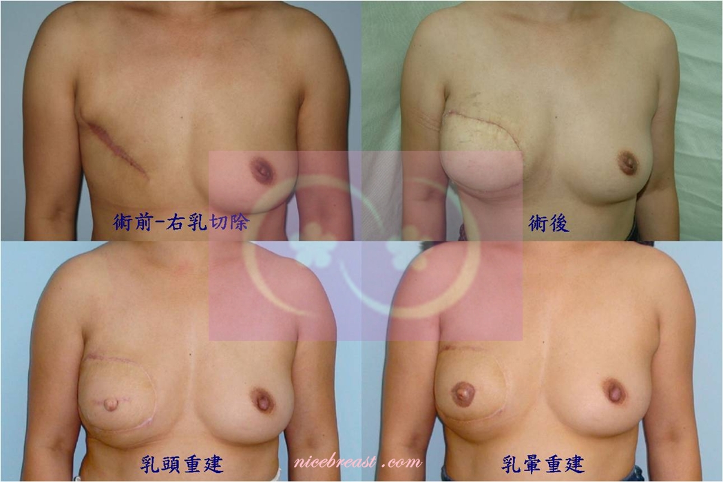 延遲性乳房重建-右乳