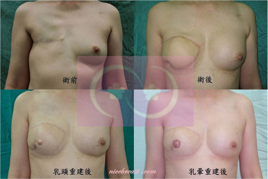 延遲性乳房重建-右乳