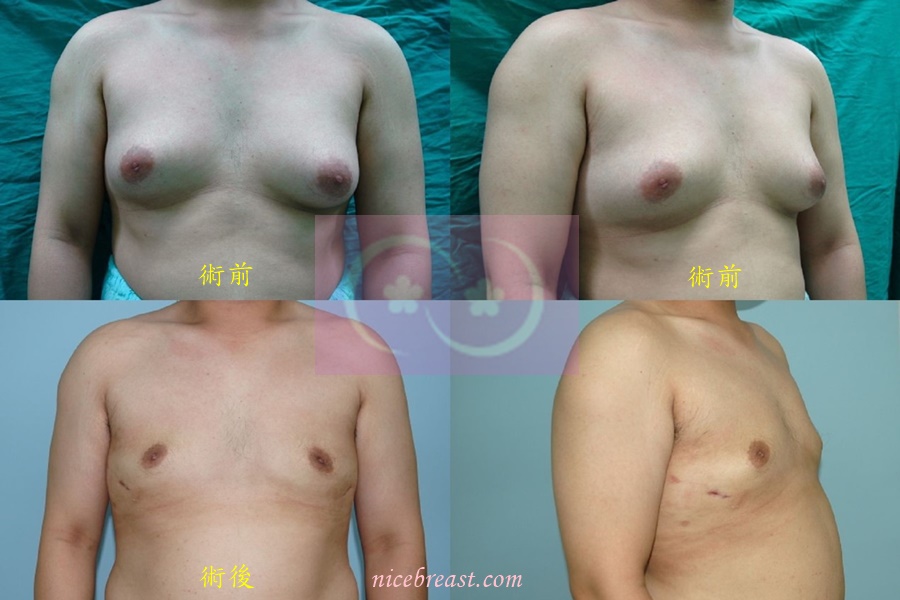 男性女乳症