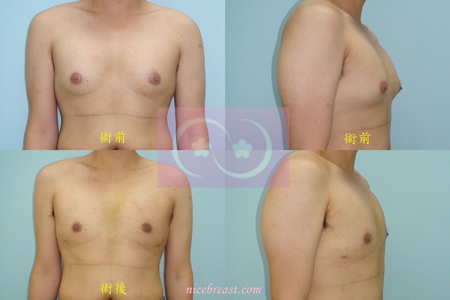 男性女乳症