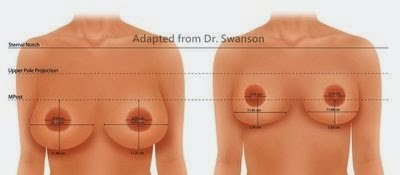 手術前後胸型變化示意圖
