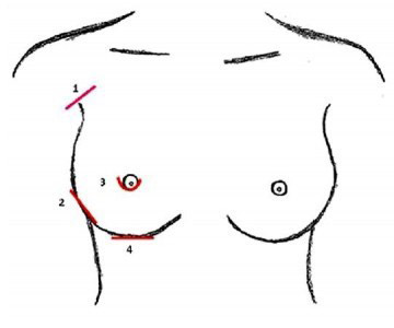 隆乳的切口可從：1.腋下、2.乳房側緣、3.下乳暈周圍、4.乳房下緣，進行手術。（照片提供／林怡伶）
