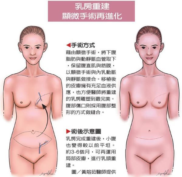 ▲乳房重建顯微手術再進化圖。（照片提供／黃嫆茹）