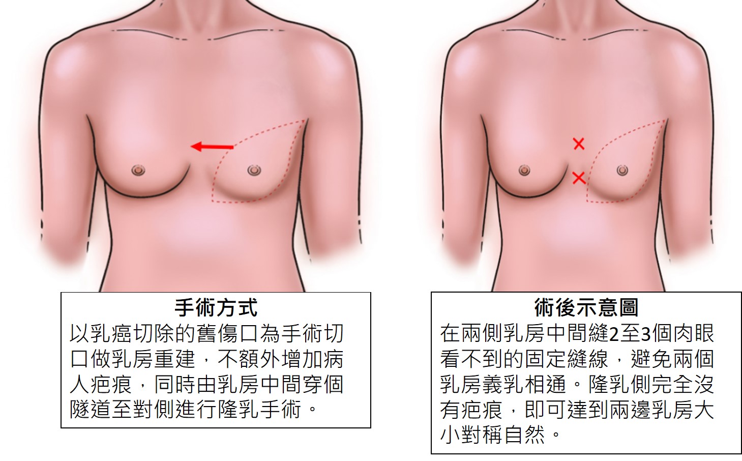 ▲乳房重建手術示意圖。