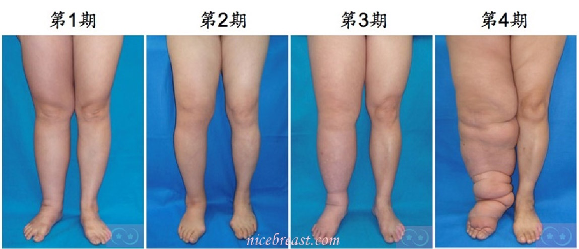 lymphedema