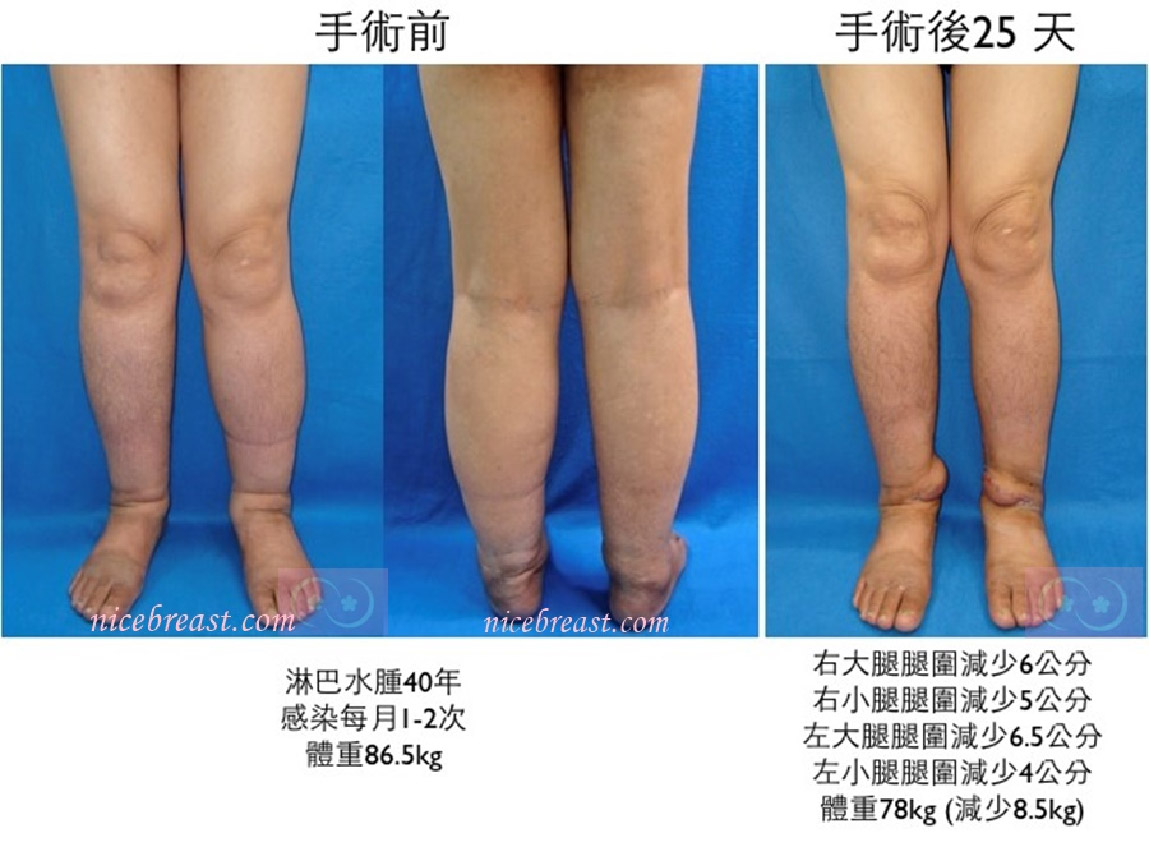 lymphedema