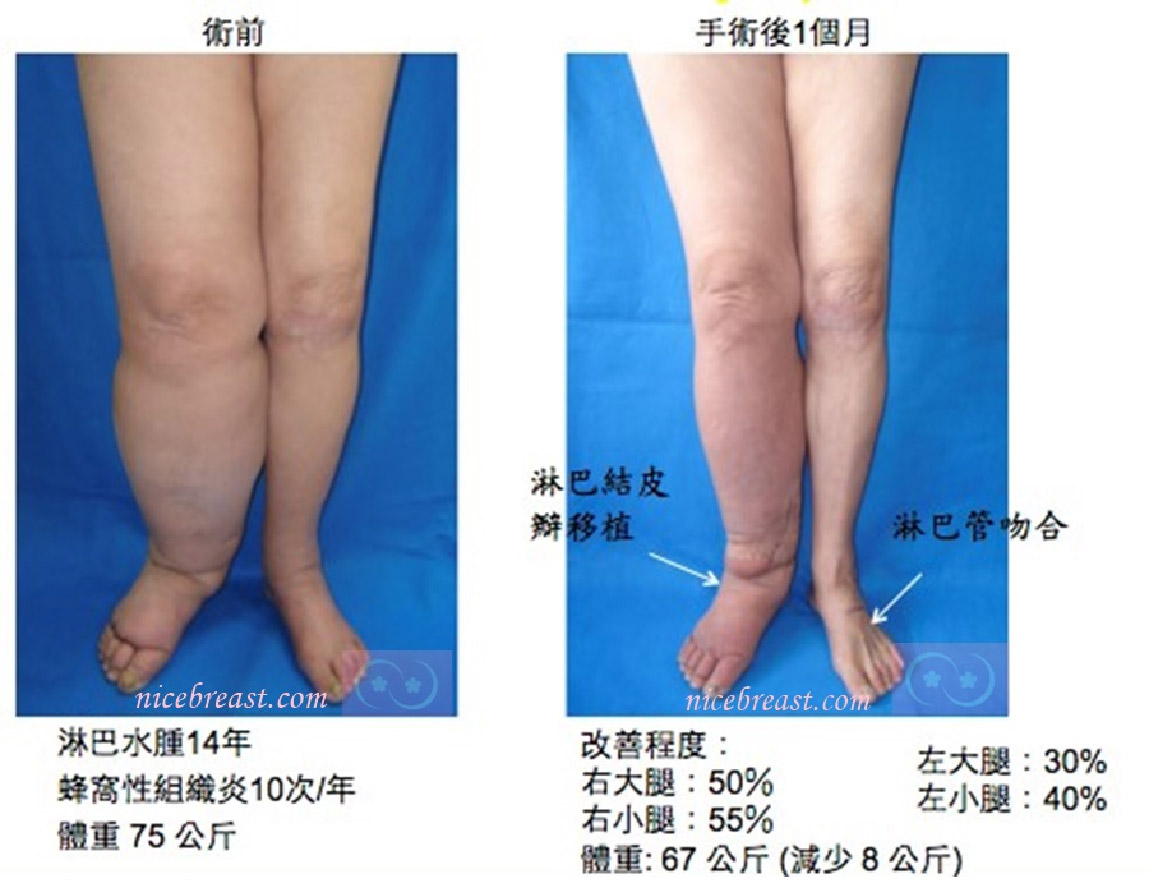 lymphedema