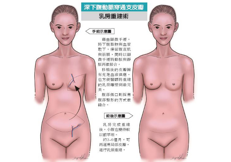 深下腹動脈穿通枝皮瓣