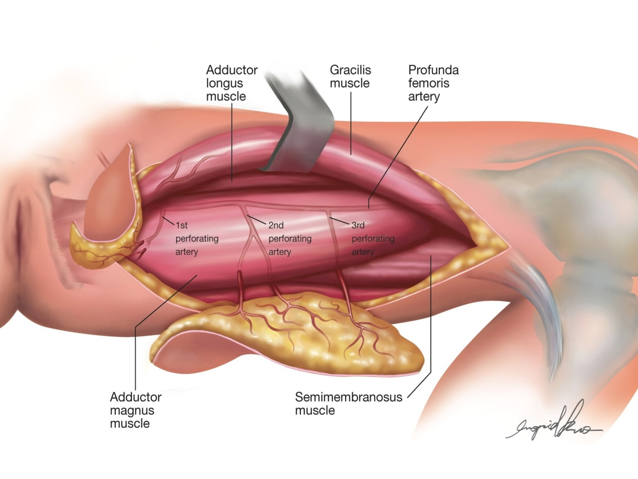 深股動脈穿通枝皮瓣( PAP flap)手術示意圖